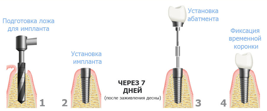 одноэтапная имплантация клиника на Динамо