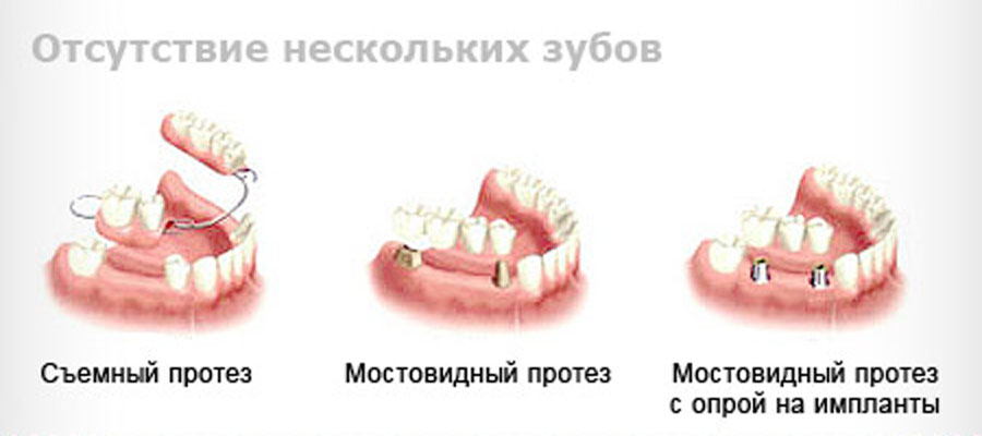 протезирование зубов