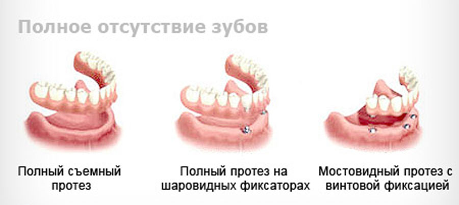 протезирование зубов