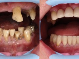 имплантация зубов  Частный Дантист и коллеги