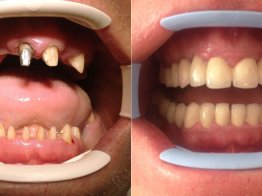 Имплантация зубов на Метро Динамо установка коронок 