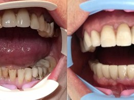 Имплантация зубов отзывы о врачах Частный Дантист и коллеги