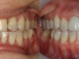 Имплантация зубов на Динамо отзывы