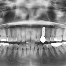 Имплантация зубов